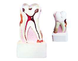ZM1049-6 牙體病理模型